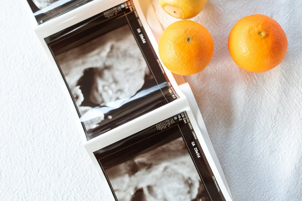 做泰國試管嬰兒胚胎移植前，要憋尿？