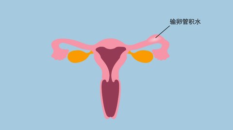 輸卵管積水能自然懷孕嗎？輸卵管積水如何懷孕？