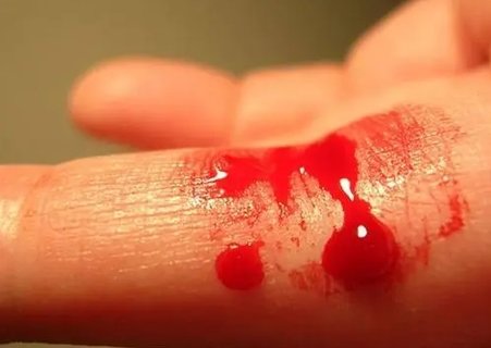 血友病做試管嬰兒會遺傳嗎？遺傳風險及預防策略