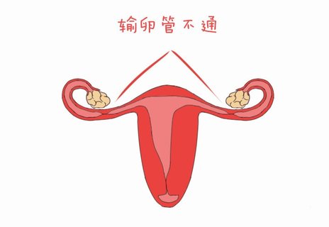 輸卵管極不通暢嚴重嗎？輸卵管極不通暢可以懷孕嗎？